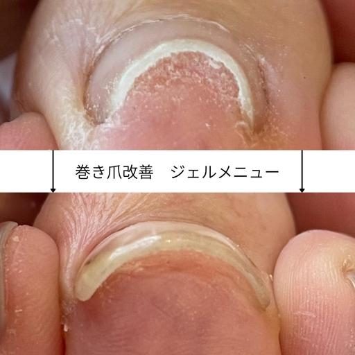 フットのお休み期間に! 【巻き爪改善ネイル】 親指2本¥2000