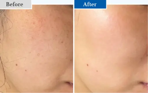 【35歳以上限定】最新ピーリングでエイジングケア💆‍♀️ダクトピール40分【顔撮影あり/要事前決済/すぐ予約不可】