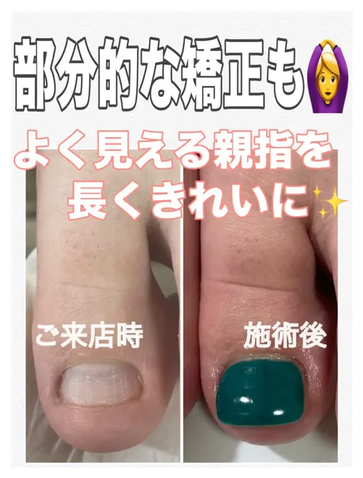 9.10月限定❤️‍🔥フット深爪矯正【長さ出し】◆ワンカラー◆(オフ込/フットバス付) 小さくなった爪も綺麗な状態に