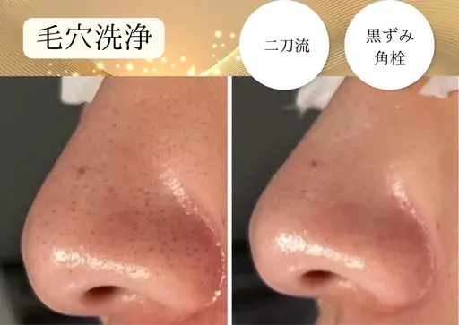 【毛穴悩みに】毛穴エクストラクション