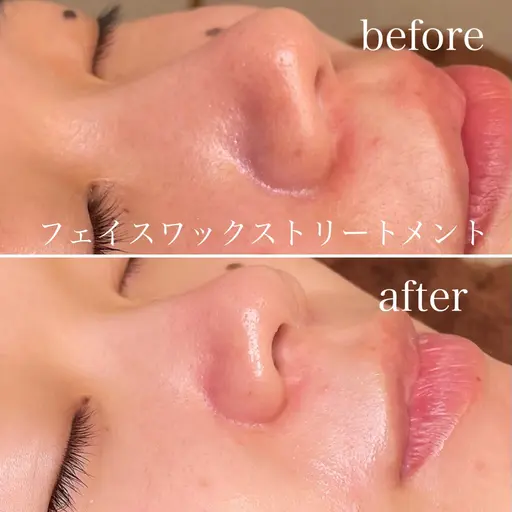 練習モデル【潤艶フェイスワックストリートメント】全顔＋鎮静パック付き