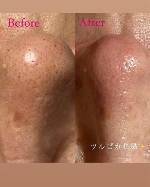 🧸お鼻WAX脱毛🧸美容液付き