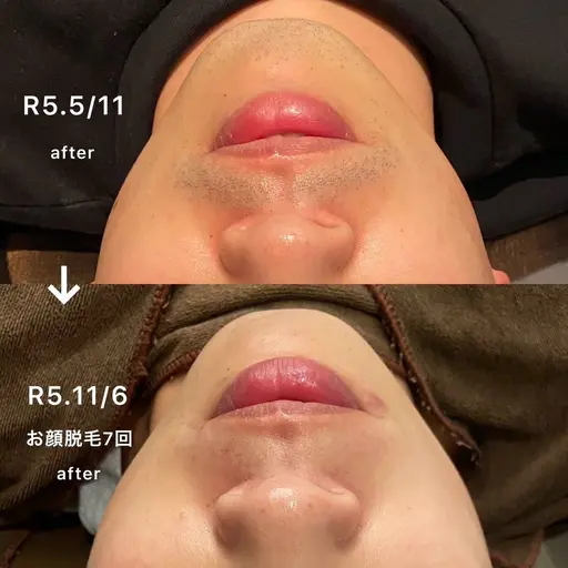 【当店圧倒的人気のお顔脱毛】気になる黒い毛、産毛や毛穴まで綺麗に🌟❗️