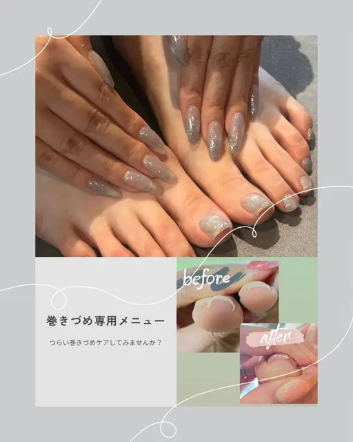 【巻き爪ケア3回/経過写真撮影モデル】左右親指1本ずつクリア仕上げ
