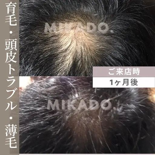 【育毛促進・頭皮ケア】頭皮の赤み、かゆみ、抜け毛に頭皮をマッサージしながら最適ハーブで育毛効果¥27500→¥22000