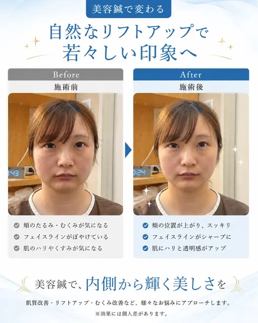 ❤️美容鍼4,500円クーポン❤️悩みに内側からアプローチ😆