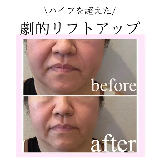 【通常価格40000円以上】💎たるみ・ほうれい線・顎下のお肉💎 フェイスライン集中ケア💆♀️マシン打ち放題