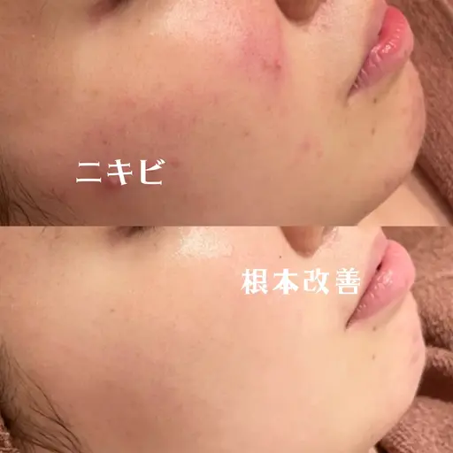 【当日直前SALE❕❕✨】肌負担0ピーリング&温熱イオンパックでニキビ撃退コース❕❕🤎