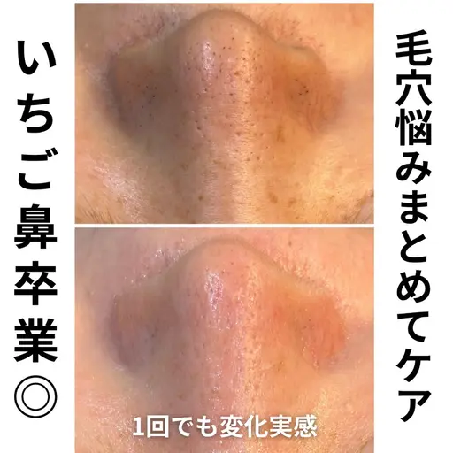 【9/18〜24限定特別価格】毛穴洗浄×肌悩み別美容液🔥黒ずみ・皮脂・ザラつきを集中ケア♪ 3000円引き!
