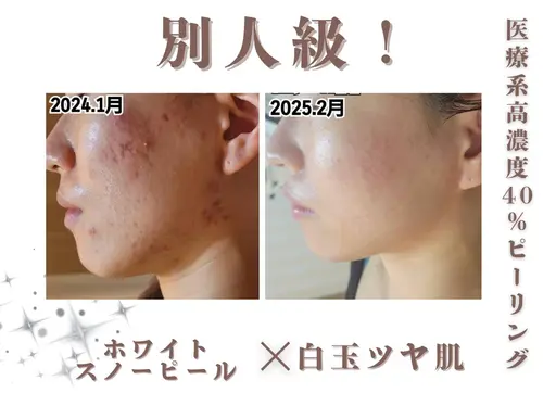 26日限定価格‼ホワイトスノーピール🐿🤍革命的な白さを追求!!!!!自慢のすっぴん肌で毛穴の黒ずみにも◎