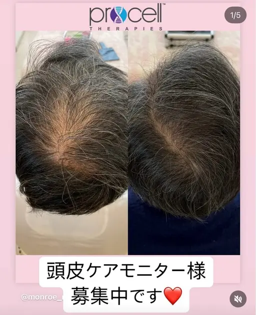 【毎月3名様限定】本気の頭皮改善ケア ¥47,000→¥40,000