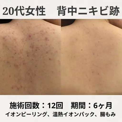 【土日限定クーポン❣️】 いつでも魅せれる肌に🥰ブライダルにも👰🏻♀️お背中集中ケア♩ピーリング+温熱ロウパック