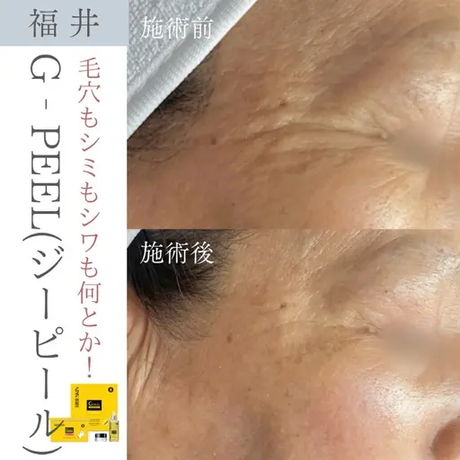 【毛穴の開き・シミ・シワケアに】G-PEEL|60分|9/30迄の期間限定価