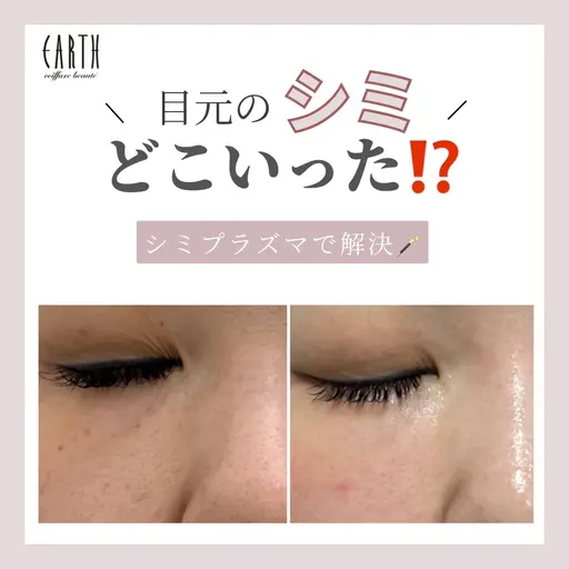 【最新シミ取り🪄＋プラズマシャワー🚿＋美容液導入】シミイボソバカス肝斑が気になる、ダウンタイムが出てもいい方◎
