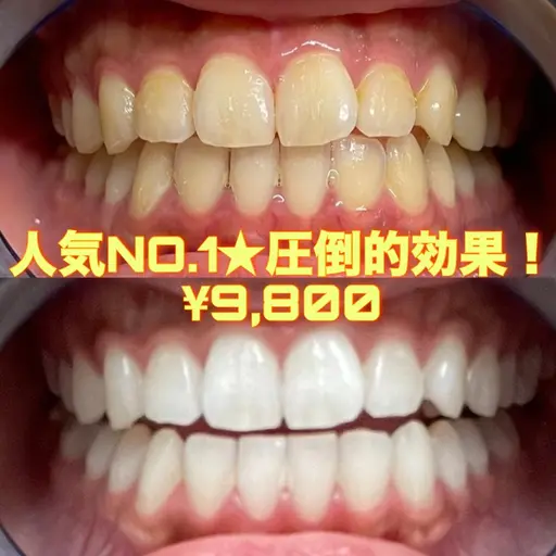 【1日2名様限定】🌈1番人気🌈【圧倒的効果！🔥】通常の6倍照射！セルフホワイトニング9,800円✨✨