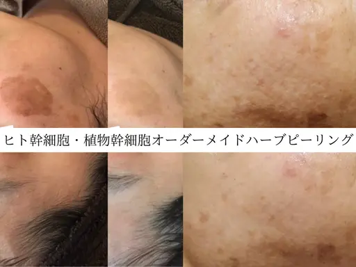 【好評につき延長🫧8月限定価格◎】肌悩み別オーダーメイドハーブピーリング【剥離なし】