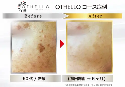 【シミが出来る根本にアプローチする次世代シミケアマシン】を使った練習モデル。メンズレディースどちらもOK!