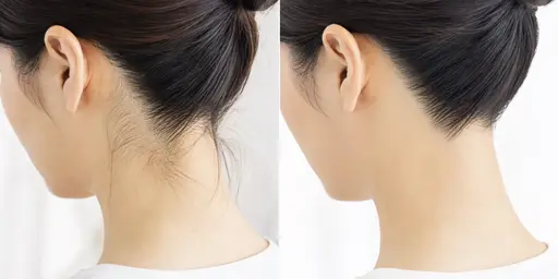 ꒰ レッスンモデル 3名様限定 ꒱ 女性うなじワックス脱毛♪