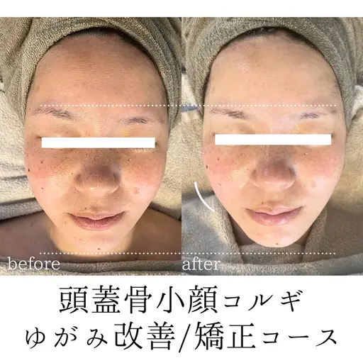 矯正コース【歪み/左右差改善】頭蓋骨小顔コルギ60分