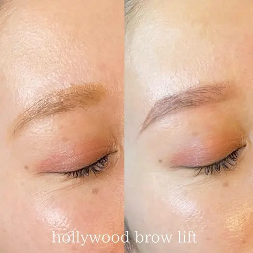 hollywood brow lift