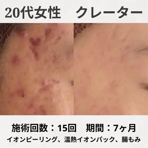 【人気NO.1👑 ̖́-‬】ニキビ跡集中！クレーター・色素沈着ニキビ跡でお悩みの方！