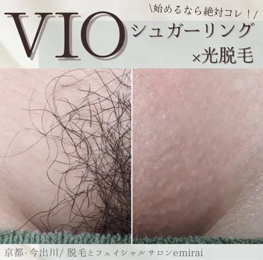 人気Ｎｏ.1✨シュガーリング🍯+最新式光脱毛✨で当日からつるつる！チクチクしないVIOmix脱毛🍯💕