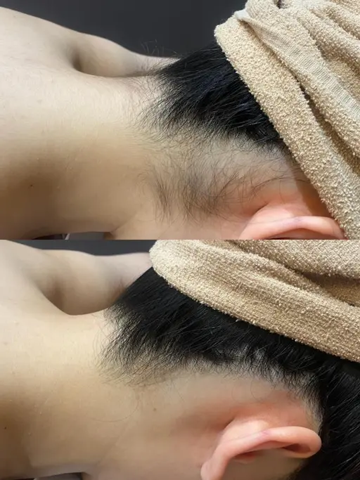 ✨29日〜31日ご来店限定✨夏前準備✨【うなじ脱毛】アップヘアが映えるうなじへ🩵デザインシェービング付IPL脱毛💖