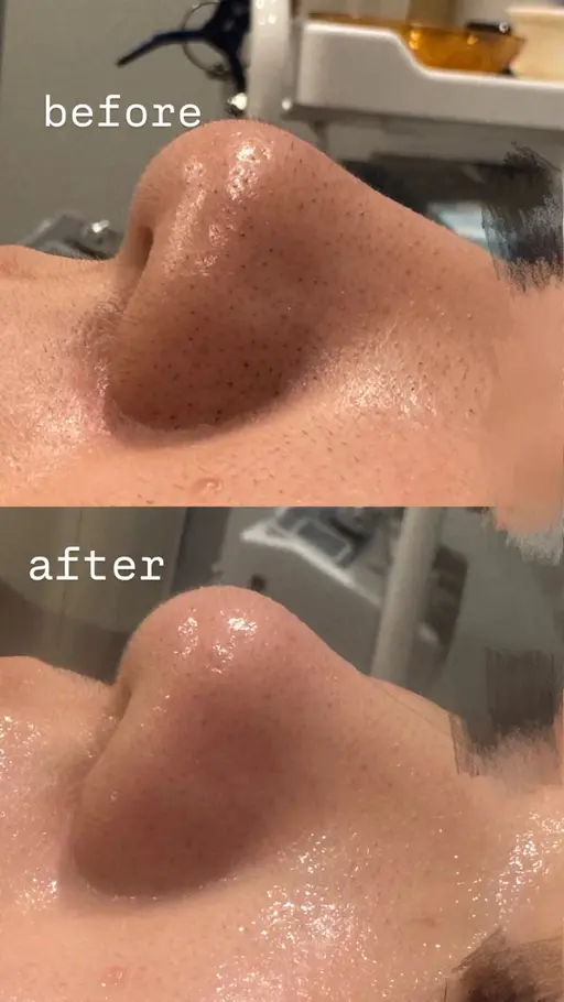 💆🏻‍♀️毛穴フェイシャルエステ💆🏻‍♀️ 練習モデル募集中！肌診断付き💚