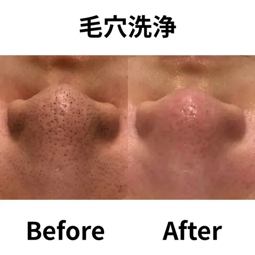 【男女/新規/花粉や皮脂対策で透明肌へ】全顔3D毛穴洗浄 初体験
