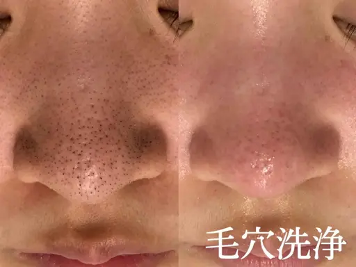 【男女/新規/花粉や皮脂対策で透明肌へ!】全顔3D毛穴洗浄 初回体験¥5500