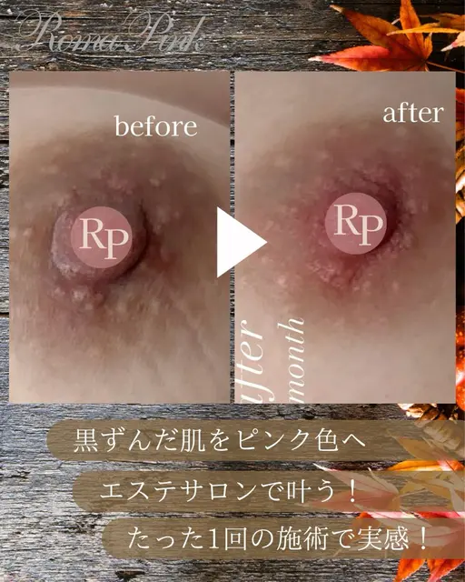 黒ずみ改善♪【RomaPink/ローマピンク★バストトップ(乳輪)】