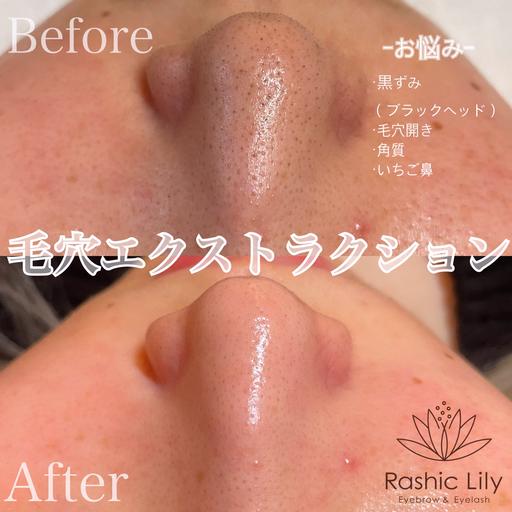【ミニモ限定】ごっそり毛穴洗浄🍓!!毛穴エクストラクション🌿美鼻ベーシックコース