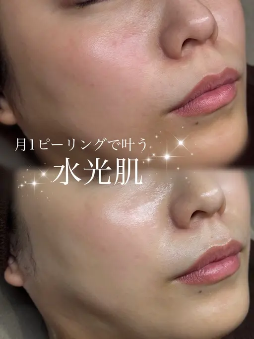 ミニモ限定価格【ニキビ/ザラつきにはこれ】ハーブピーリング、オイルデコルテ/肩/首マッサージ付き♪