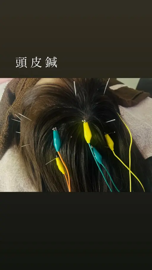 【脳疲労・頭痛・不眠】 電気頭皮鍼+アロマヘッドマッサージ