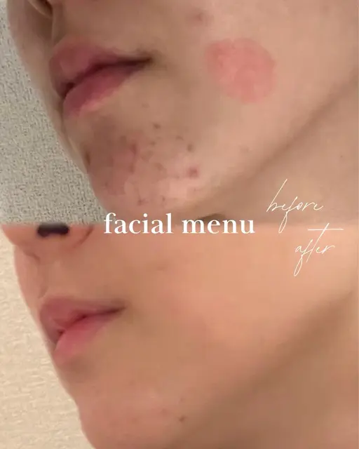【無料体験】毛穴ごっそり体験🩰