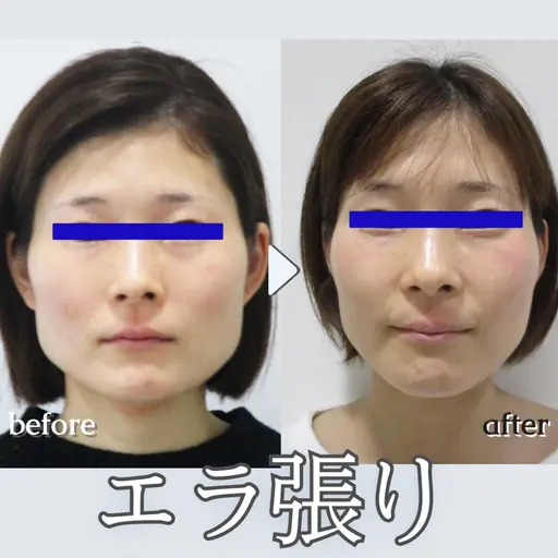 👑全国人気NO.1!👑【小顔矯正+美顔マッサージ】+【首肩矯正】💆 50分<顔やせ/エラ張り/首を長く細くなど>