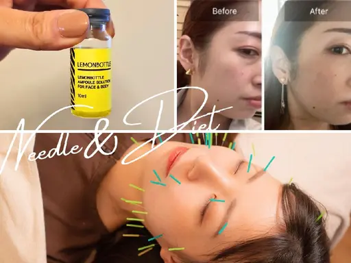 【脂肪がなくなる!?美容鍼】鍼灸初!脂肪サヨナラ👋美容鍼|クリニックじゃなくて夢は叶う✨両頬・二重顎をスッキリ!