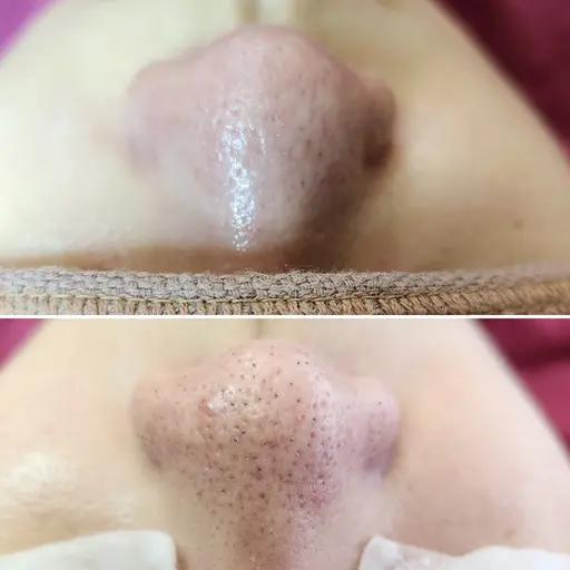 小鼻の黒ずみごっそり🫧小鼻ツルツル✨毛穴エクストラクション