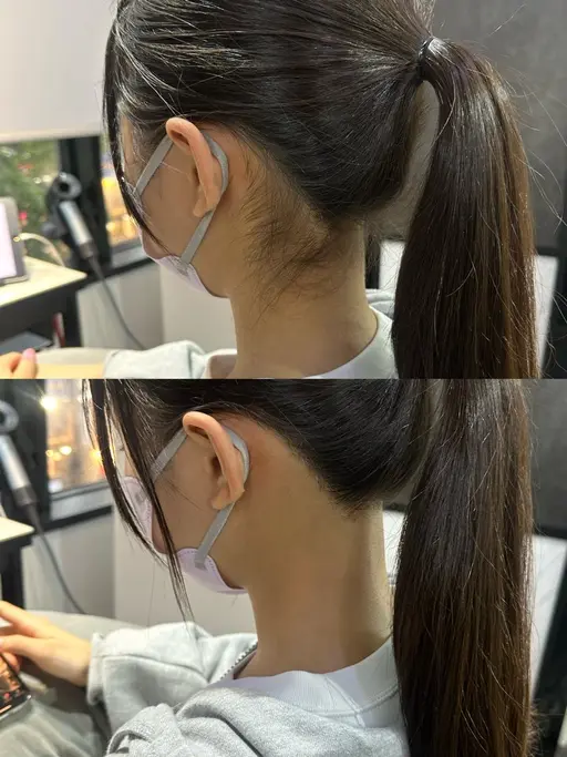 うなじ脱毛