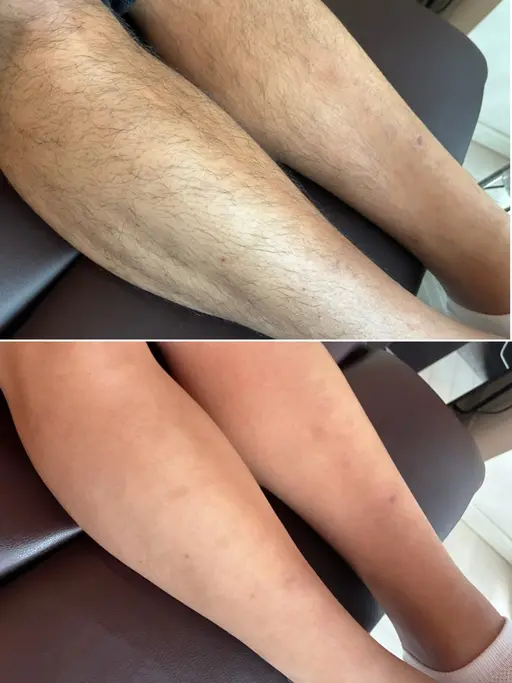 【蒲田駅徒歩2分】夏準備スタート🌻 腕＆脚　wax光脱毛で速攻ツルスベ肌へ！men's