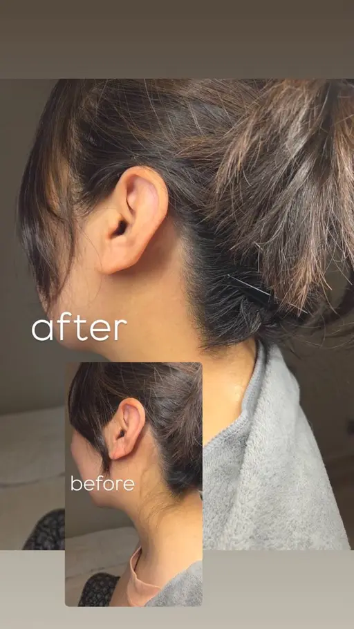 フェイシャルワックス+うなじwax脱毛