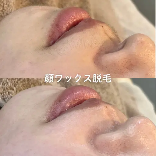産毛まで抜ける◎顔ワックス脱毛