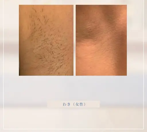 【U24⭐️脱毛体験先着10名】両脇〜高出力照射脱毛〜