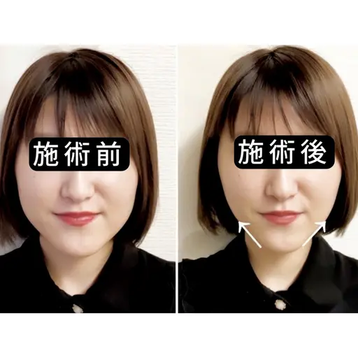 【迷ったらコレ】むくみ・左右差｜小顔矯正×EMS美容鍼 50分
