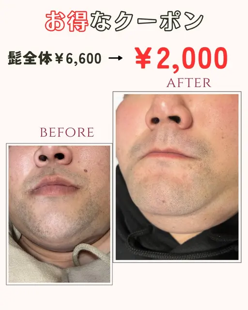 メンズヒゲ全体脱毛¥6,600→¥2,000