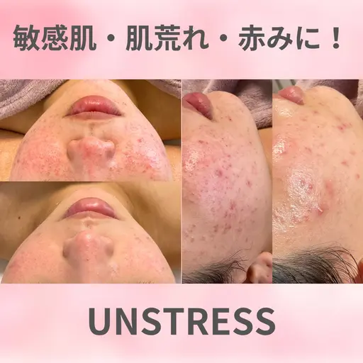 水光肌ミルクピーリング〝アンストレス〟🩵繰り返す肌荒れ・かゆみ・ごわつき・敏感肌にはこれ!ダウンタイム無し✨
