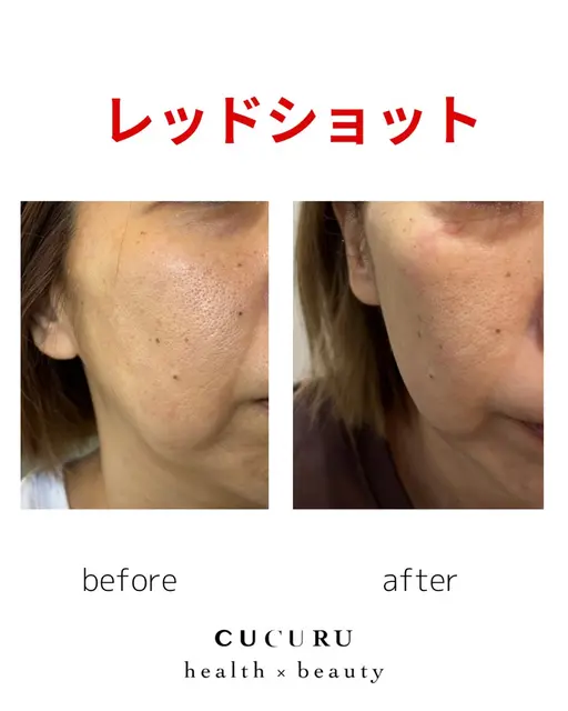 切らずに小顔レッドショット!気になる二重アゴ、フェイスラインをスッキリ小顔へ✨プラズマ導入で乾燥、ニキビも一緒にケア