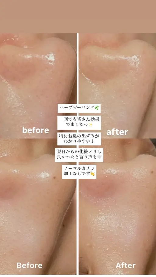 剥離なし🌿ハーブピーリング(顔)モニターさま
