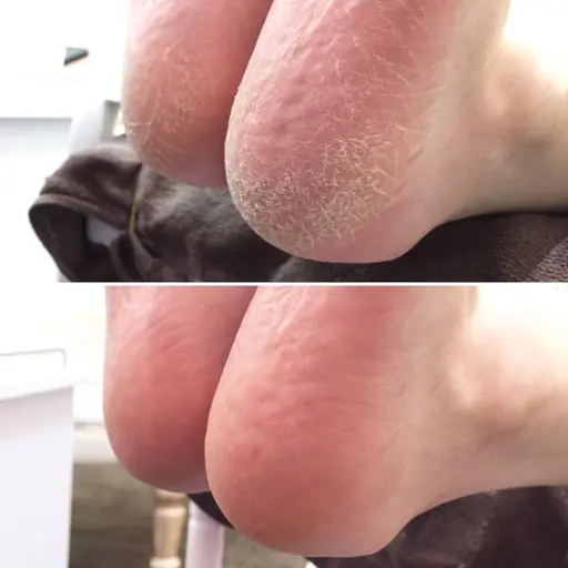 【かかと角質ケア】驚くほど取れますよ!保湿しながら角質を取るのでつるつる・モチモチの仕上がり😊