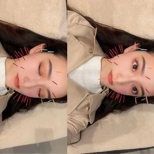 月曜・水曜限定🌱【小顔美容鍼】起きたときのむくみ、寝ている時の食いしばりが気になる方におすすめ